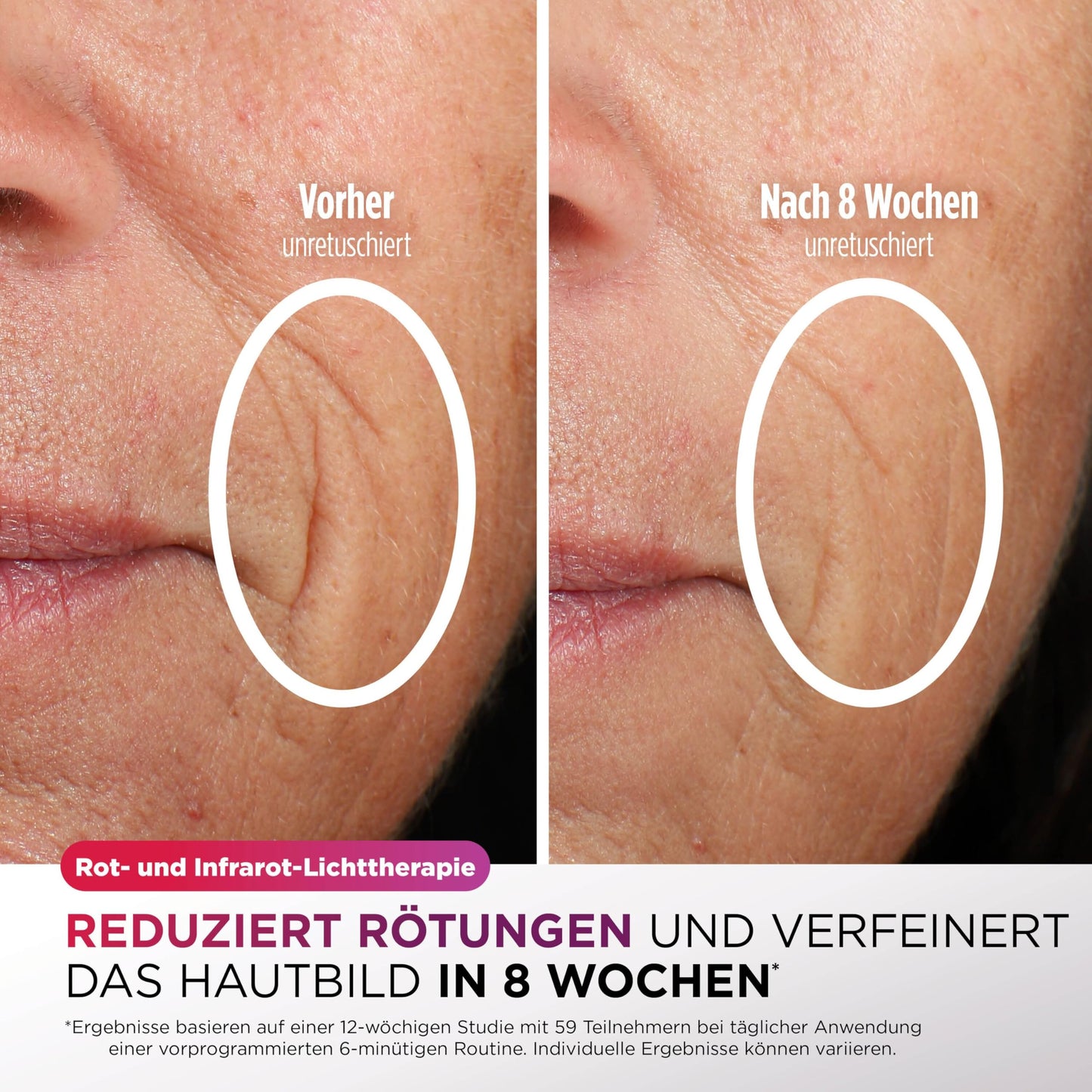 Shark CryoGlow LED Gesichtsmaske mit Augen-Kühlung Anti-Aging Akne Lichttherapie Rot Blau Infrarot USB-C FW312EUPL